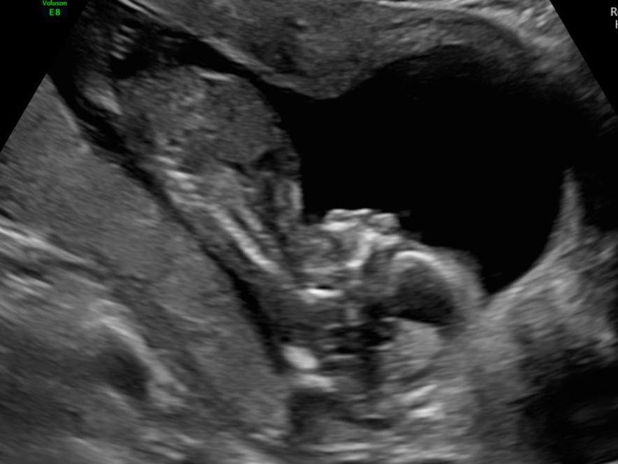 ~Quick Peek 13 weeks to 23 weeks 6 days $65